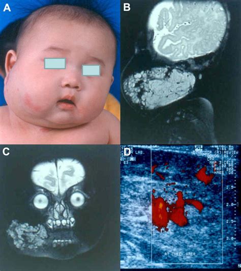 A Infantile Hemangioma Seen As A Rapidly Expanding Lesion Along The