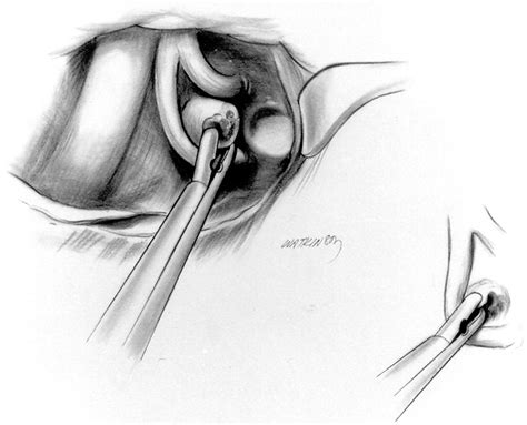 Transaxillary First Rib Resection For Thoracic Outlet Syndrome