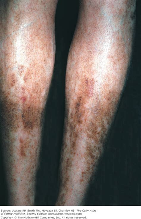 Diabetic Spots On Legs