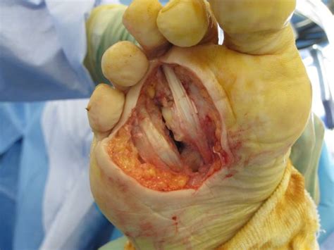 Squamous Cell Carcinoma Of The Foot A Case Report The