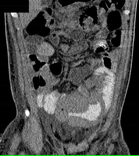 Small Bowel Lymphoma Small Bowel Case Studies Ctisus Ct Scanning