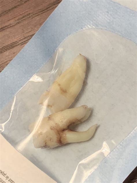 Wisdom Teeth Almost Always Have Fused Roots One Of Mine Had Three