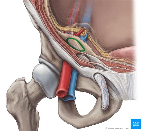 The inguinal canal is a tubular structure that runs inferomedially and contains the spermatic cord in males and the round ligament in females. A case of a giant inguinal hernia: Anatomy and images | Kenhub