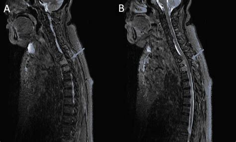 Cureus Thoracic Spinal Cord Compression Secondary To Metastatic