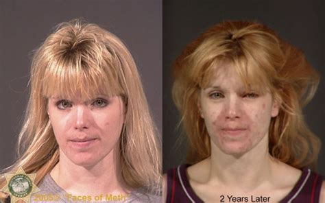 Meth Addicts Before And After Pics Izismile Com