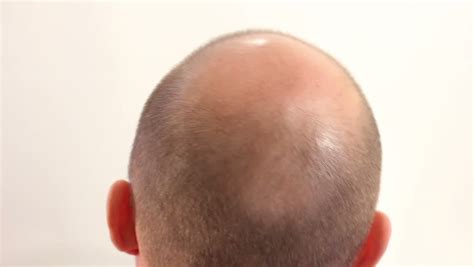 Bald Spot On Back Mans Head Stock Footage Video 100 Royalty Free