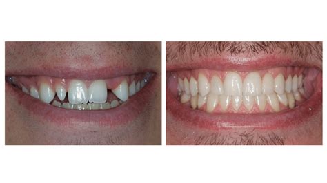Palmetto Dental Associates — Missing Lateral Incisors