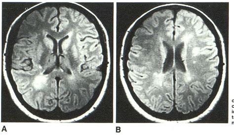Figure 4 From High Signal Periventricular Lesions In Patients With