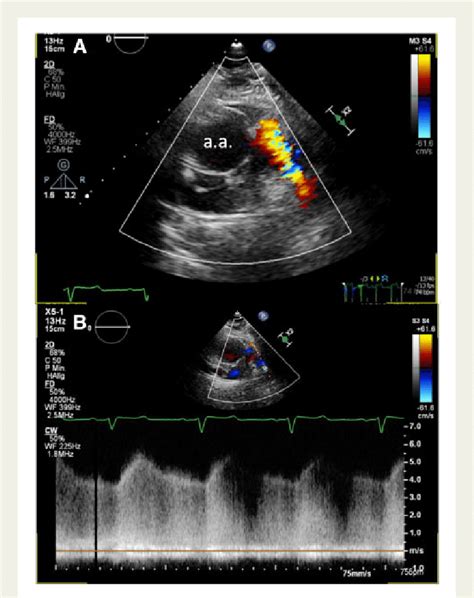 Parasternal Short Axis View Of Transthoracic Echocardiography Top A