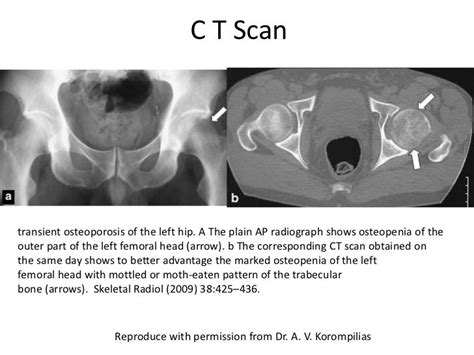 Transient Osteoporosis Of Hip