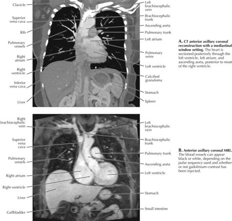 Thorax Radiology Key