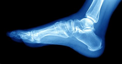 Lateral Malleolus Fracture Symptoms And Treatment