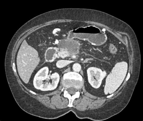 Pancreatic Adenocarcinoma With Liver Metastases Adrenal Case Studies