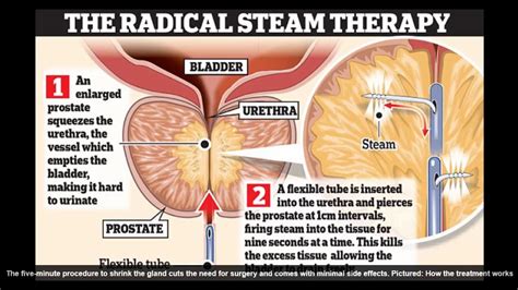 Rezum Steam Treatment For Prostate Enlargement Youtube