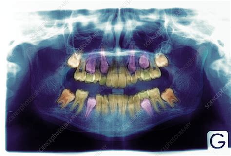 Emergence Of Adult Teeth X Ray Stock Image P4860135 Science
