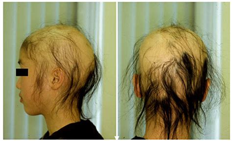 Hair loss bald patch dogs in conjunction with other medical symptoms. Clinical feature on initial examination. Bald patches of ...