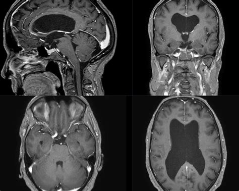 Triventrikulärer Hydrocephalus Ars Neurochirurgica