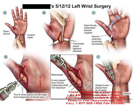 Amicus Illustration Of Amicus Surgery Hand Wrist Wound K Wires Fragments Metacarpel Thumb Shaft