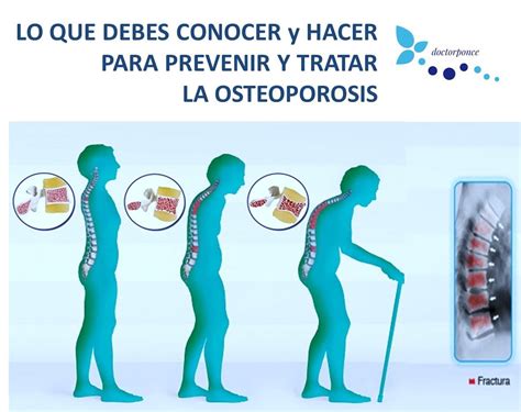 Lo Que Debes Saber Para Prevenir Y Tratar La Osteoporosis Clínica