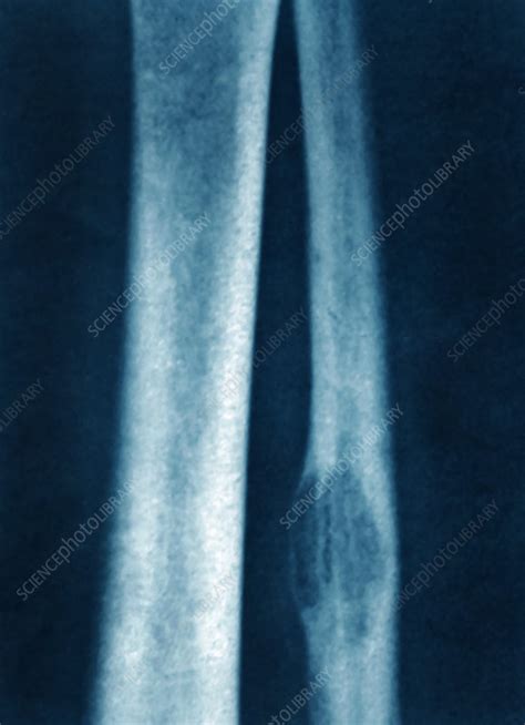 Check spelling or type a new query. Bone metastasis - Stock Image - C027/1050 - Science Photo ...