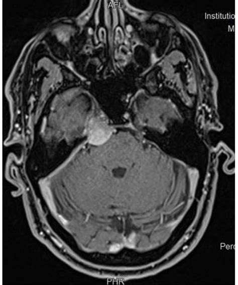 T1 Mri With Contrast Coronal Showing The Mass Near The Right