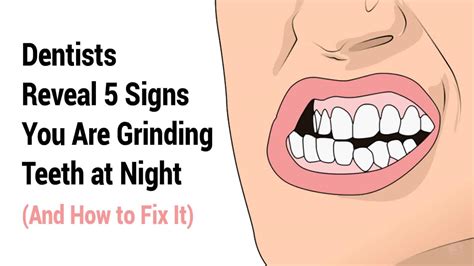 Dentists Reveal 5 Signs You Are Grinding Teeth At Night And How To Fix It
