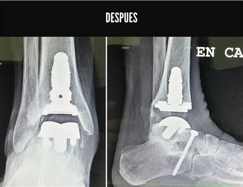 Prótesis De Tobillo Especialistas En Cirugía De Pie Y Tobillo