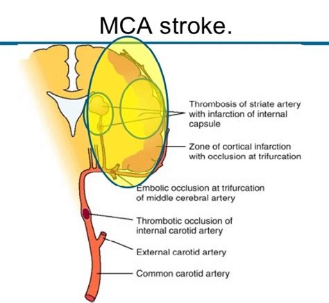 Each area of the brain is responsible for a specific function or ability. What Are the Common Symptoms of Middle Cerebral Artery ...