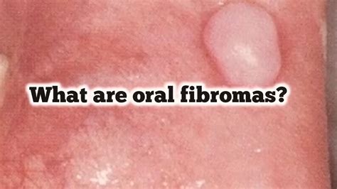 What Are Oral Fibromas Are They Benign Lesions Youtube