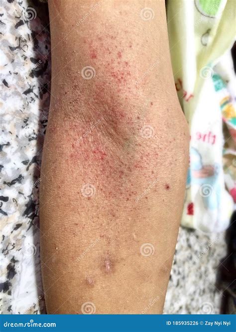 Group Of Small Red Spots Or Petechiae At Cubital Fossa Area Of Forearm