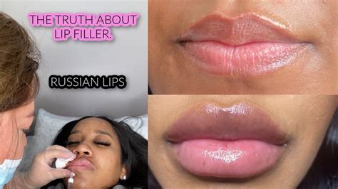 Lip Filler Vlog Russian Technique Before During And After Youtube