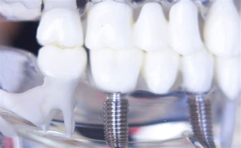 Implante Dental De Titanio Ligereza Y Durabilidad
