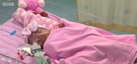 Baby Vanellope Born With Ectopia Cordis At Glenfield Hospital In