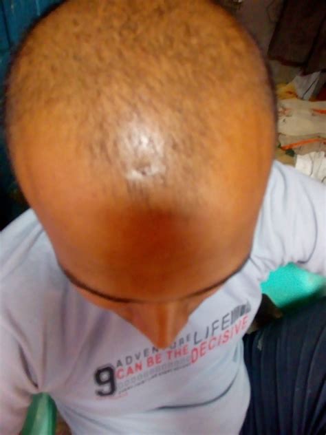 High blood pressure has been linked to heart disease, diabetes, and premature death. Saran Skin Clinic :- Best Skin Specialist in Vasundhara ...