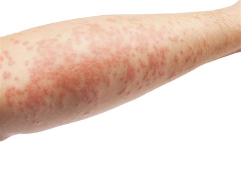 Common Skin Rashes Pictures Causes And Treatments United States