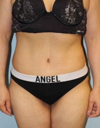 Abdominoplasty Tummy Tuck Before And After Photos Las Vegas