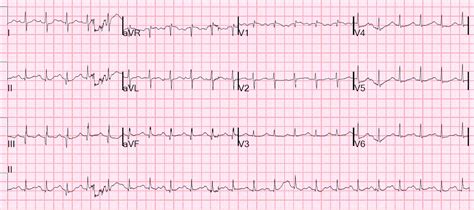 Dr Smiths Ecg Blog Why Did This Patient Have Ventricular Fibrillation