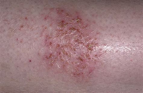 Bacterial Eczema Pictures 41 Photos And Images