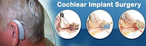 Cochlear Implant Surgery Cost In India Best Cochlear Implant Surgeon