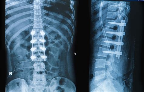 What Are The Different Types Of Spinal Injuries
