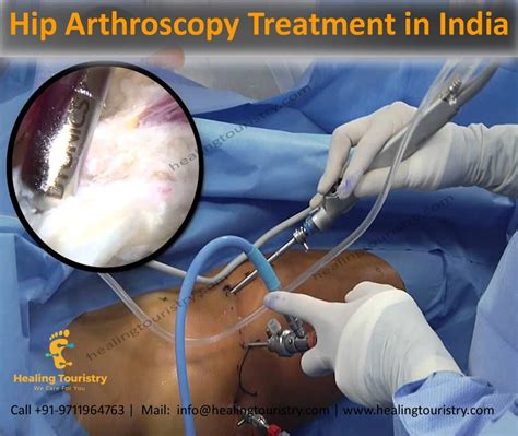 Hip Arthroscopy Is An Invasive Surgical Procedure In Which The Surgeon