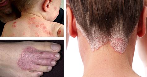 12 Natural Remedies For Eczema Rashes And A Range Of