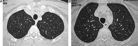 Bronquiolitis Respiratoria Asociada A Enfermedad Pulmonar Intersticial Download Scientific