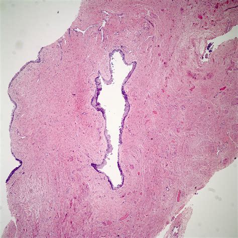 mullerian cyst