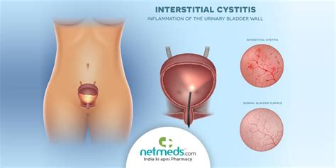 Interstitial Cystitis Bladder Pain Syndrome Causes Symptoms And Treatment