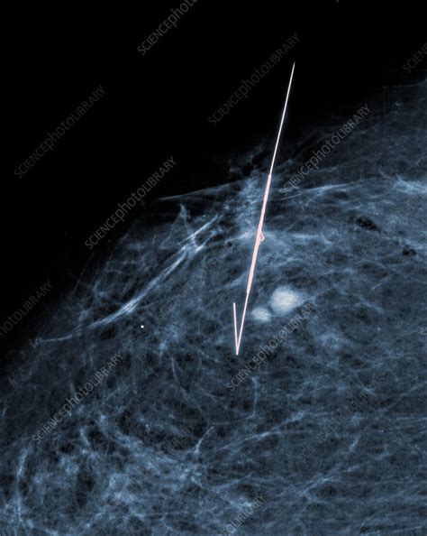 Stereotactic Biopsy Of Breast Stock Image C0094670 Science Photo