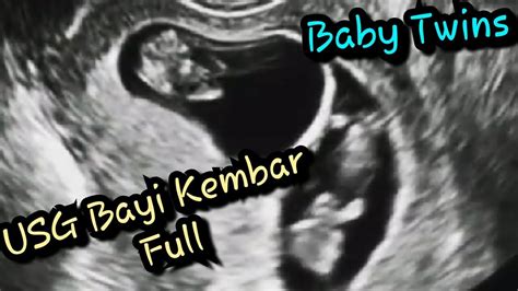Usg Kehamilan Bayi Kembar 6 32 Minggu Full Baby Twins Ultrasound