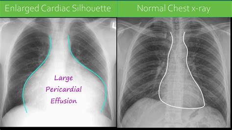 Chest X Ray Pericardial Effusion Youtube