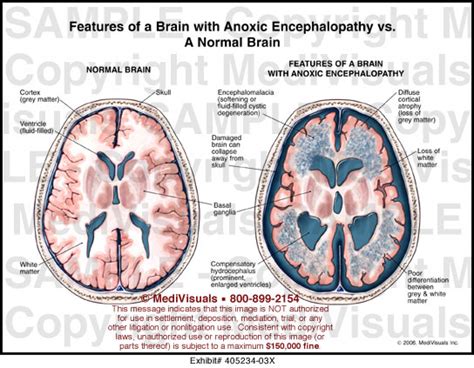 Features Of A Brain With Anoxic Encephalopathy Vs A Normal Brain
