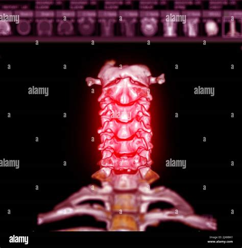 Ct Scan Of Cervical Spine C Spine Patient Trauma Case 3d Rendering